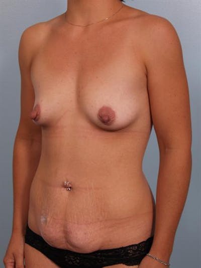 Breast Augmentation Before & After Gallery - Patient 1310228 - Image 1