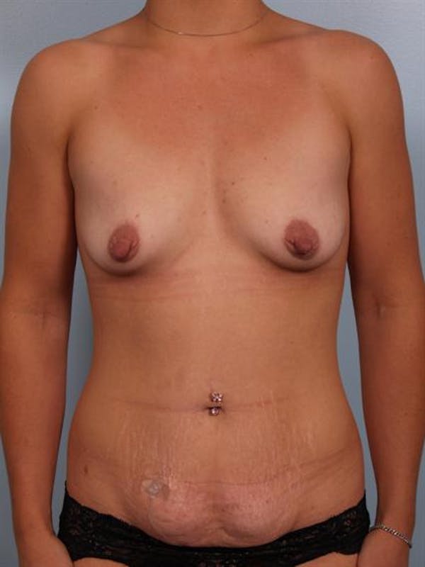 Breast Augmentation Before & After Gallery - Patient 1310228 - Image 3