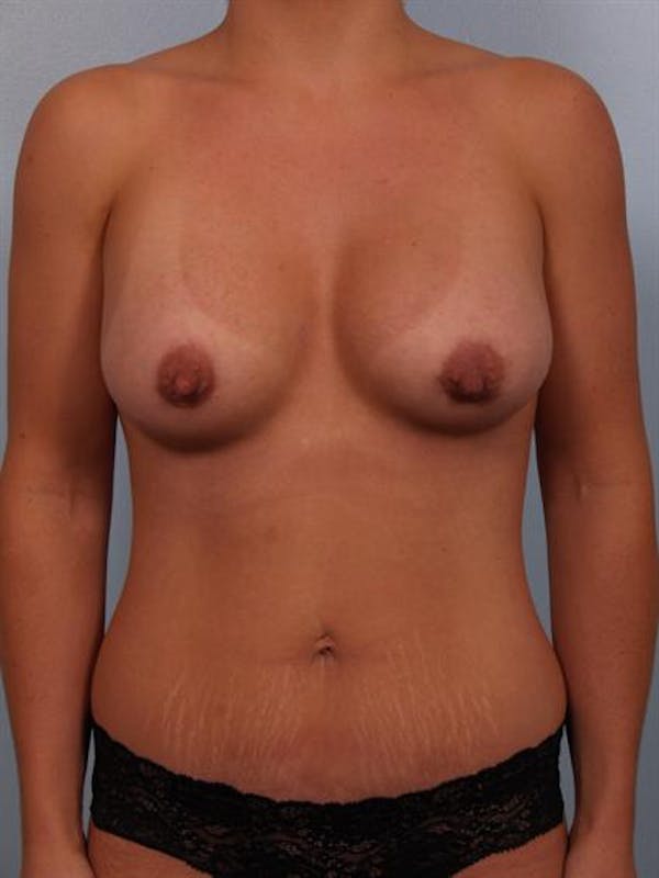 Breast Augmentation Gallery - Patient 1310228 - Image 4