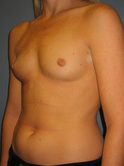 Breast Augmentation Before & After Gallery - Patient 1310229 - Image 1