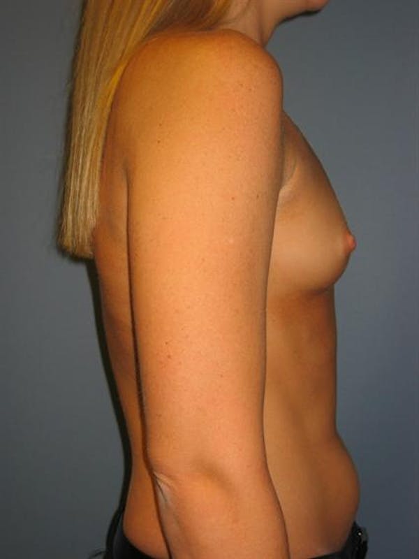 Breast Augmentation Gallery - Patient 1310229 - Image 3
