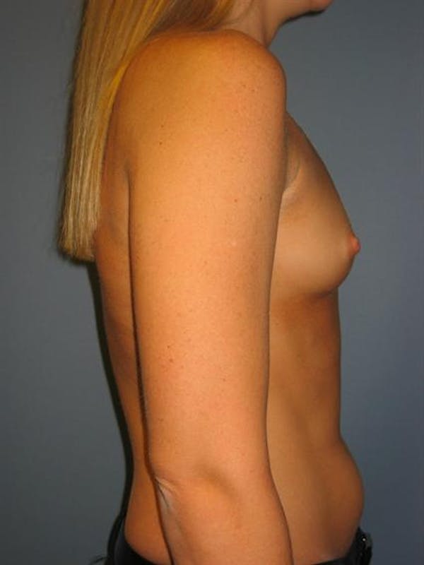 Breast Augmentation Before & After Gallery - Patient 1310229 - Image 3