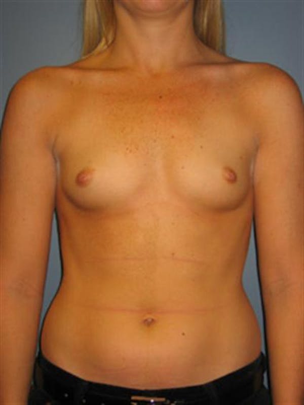Breast Augmentation Before & After Gallery - Patient 1310229 - Image 5