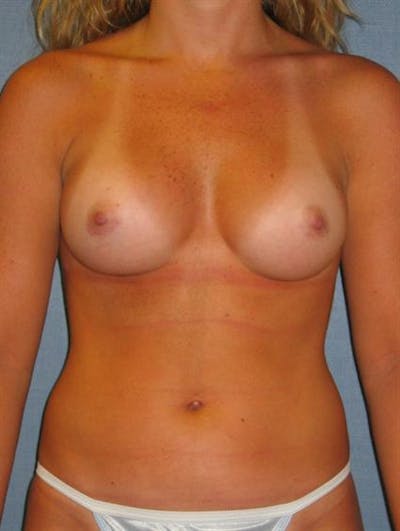 Breast Augmentation Before & After Gallery - Patient 1310229 - Image 6