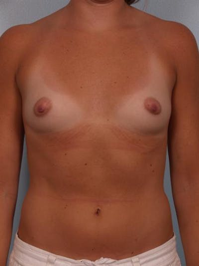 Breast Augmentation Before & After Gallery - Patient 1310231 - Image 1