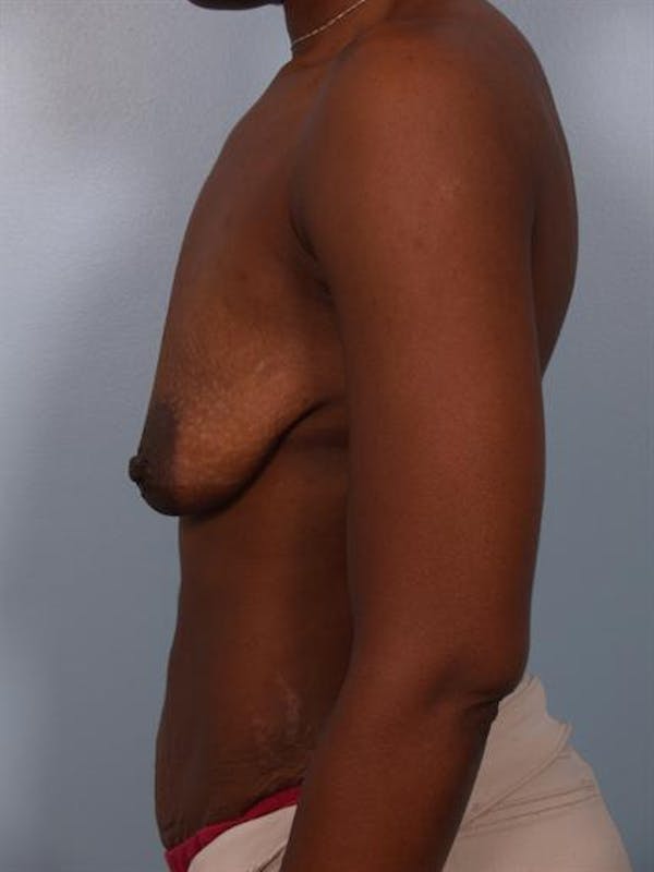 Breast Augmentation Before & After Gallery - Patient 1310232 - Image 5