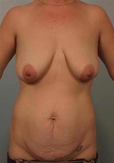 Breast Augmentation Before & After Gallery - Patient 1310233 - Image 1