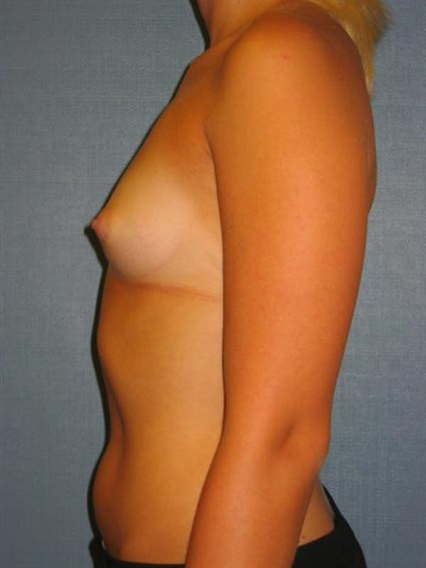 Breast Augmentation Before & After Gallery - Patient 1310234 - Image 3