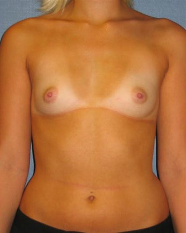 Breast Augmentation Before & After Gallery - Patient 1310234 - Image 5