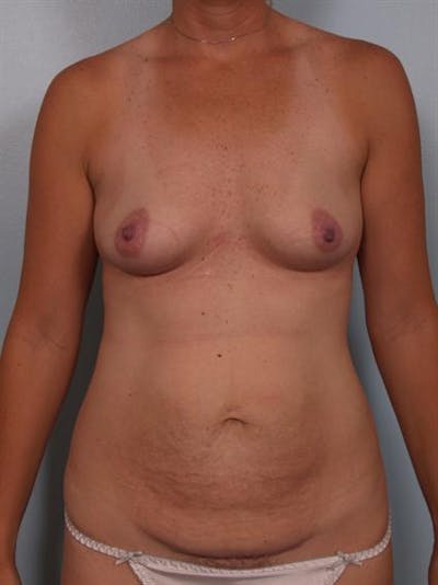 Breast Augmentation Before & After Gallery - Patient 1310235 - Image 1