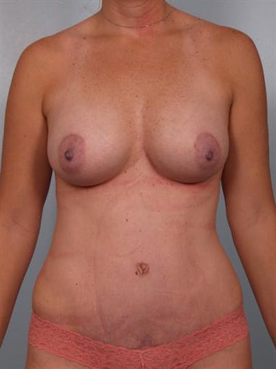 Breast Augmentation Before & After Gallery - Patient 1310235 - Image 2