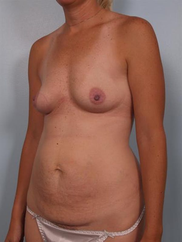 Breast Augmentation Before & After Gallery - Patient 1310235 - Image 5