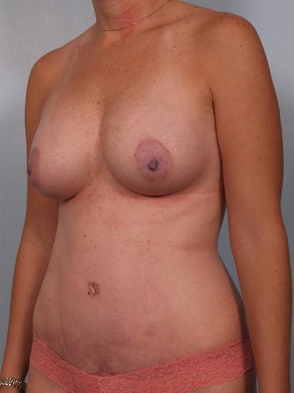 Breast Augmentation Before & After Gallery - Patient 1310235 - Image 6