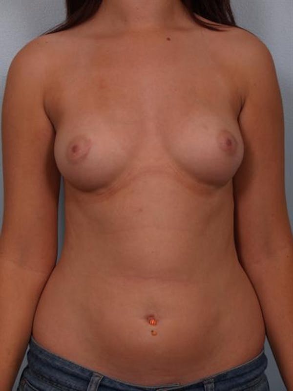 Breast Augmentation Before & After Gallery - Patient 1310236 - Image 1