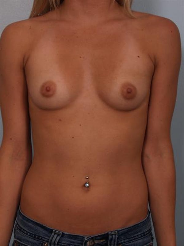 Breast Augmentation Before & After Gallery - Patient 1310240 - Image 5