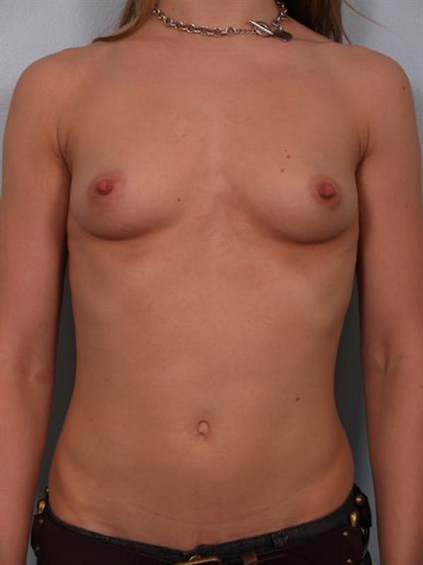 Breast Augmentation Before & After Gallery - Patient 1310245 - Image 1