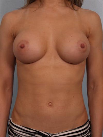 Breast Augmentation Before & After Gallery - Patient 1310245 - Image 2