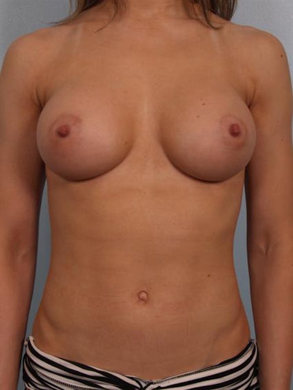Breast Augmentation Before & After Gallery - Patient 1310245 - Image 2