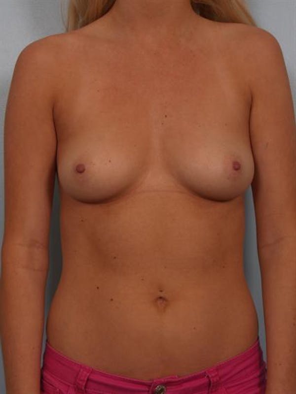Breast Augmentation Before & After Gallery - Patient 1310246 - Image 1