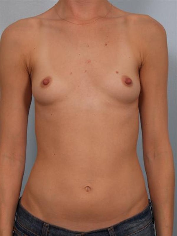 Breast Augmentation Before & After Gallery - Patient 1310247 - Image 3