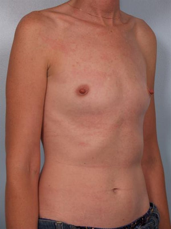 Breast Augmentation Before & After Gallery - Patient 1310257 - Image 1