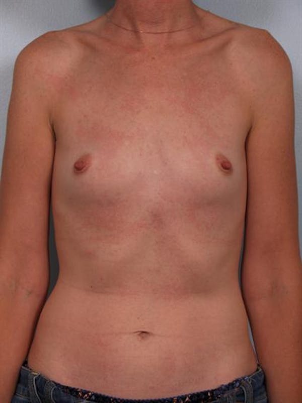 Breast Augmentation Before & After Gallery - Patient 1310257 - Image 3