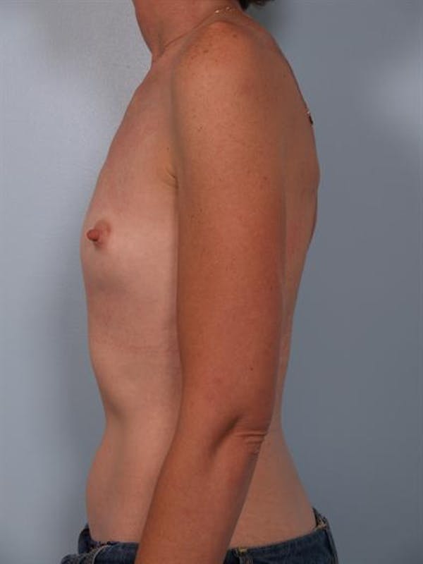 Breast Augmentation Gallery - Patient 1310257 - Image 5