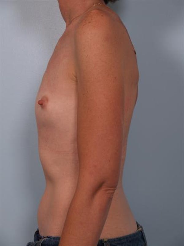 Breast Augmentation Before & After Gallery - Patient 1310257 - Image 5