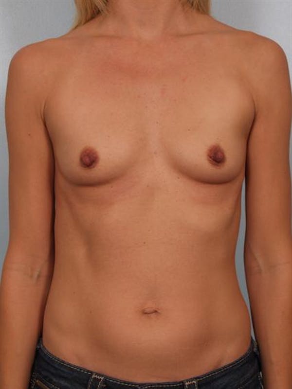 Breast Augmentation Before & After Gallery - Patient 1310258 - Image 3