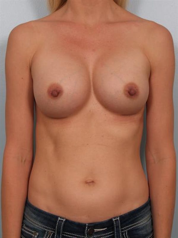 Breast Augmentation Before & After Gallery - Patient 1310258 - Image 4
