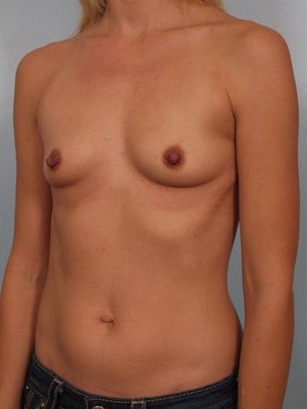 Breast Augmentation Before & After Gallery - Patient 1310258 - Image 5