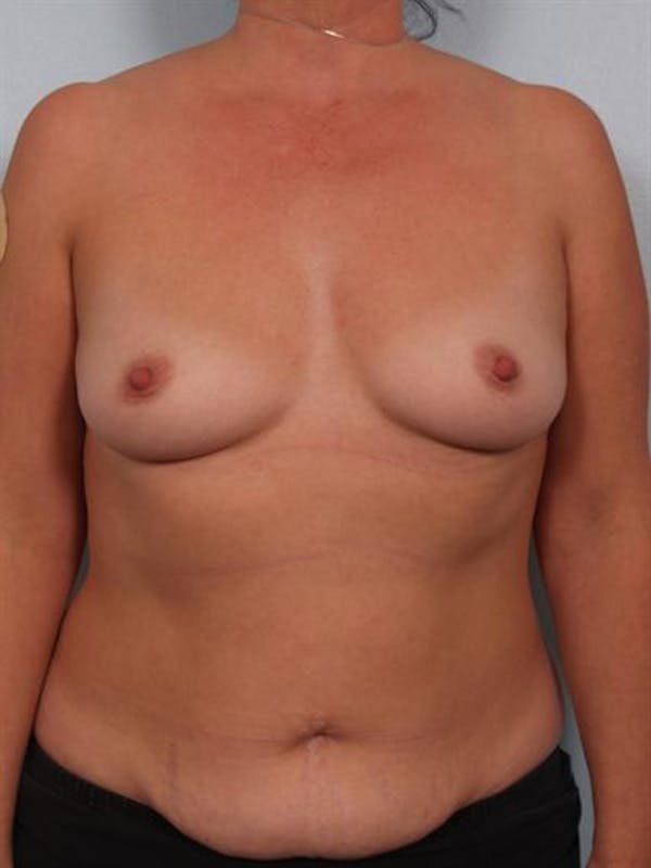 Breast Augmentation Before & After Gallery - Patient 1310262 - Image 1