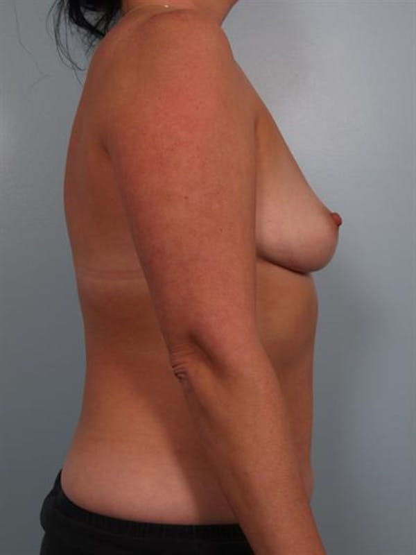 Breast Augmentation Before & After Gallery - Patient 1310262 - Image 3