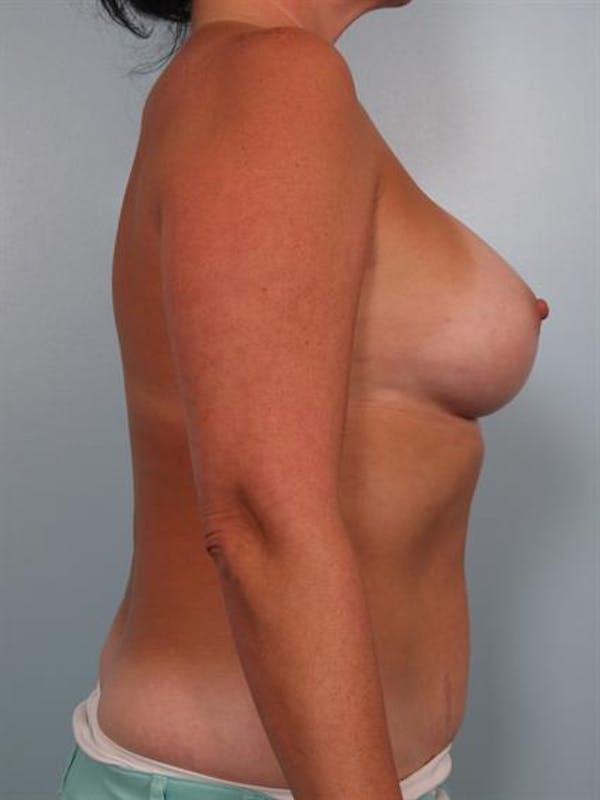 Breast Augmentation Before & After Gallery - Patient 1310262 - Image 4