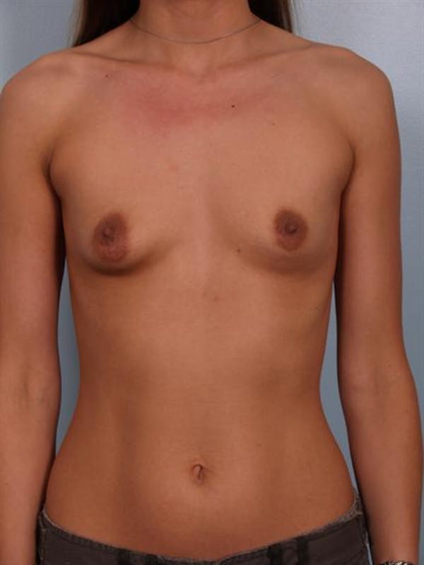 Breast Augmentation Gallery - Patient 1310263 - Image 5