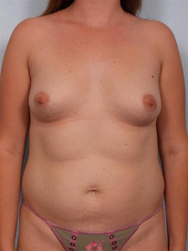 Breast Augmentation Before & After Gallery - Patient 1310264 - Image 3