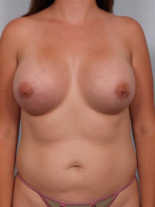 Breast Augmentation Before & After Gallery - Patient 1310264 - Image 4