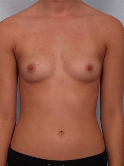 Breast Augmentation Before & After Gallery - Patient 1310266 - Image 1