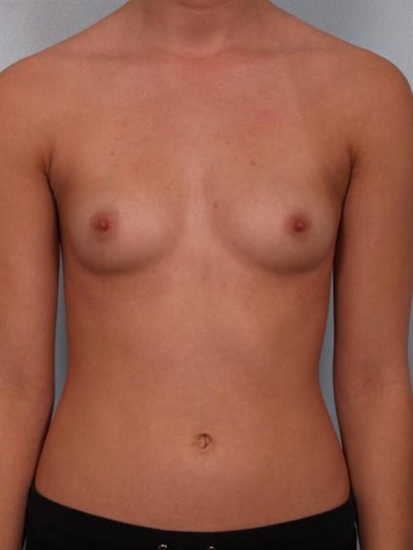 Breast Augmentation Before & After Gallery - Patient 1310266 - Image 1