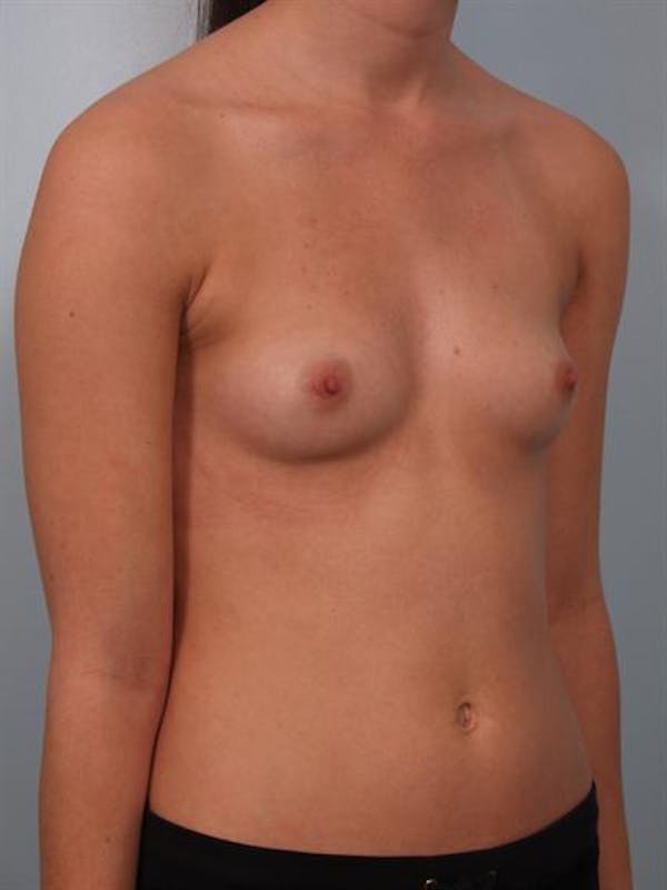 Breast Augmentation Before & After Gallery - Patient 1310266 - Image 5