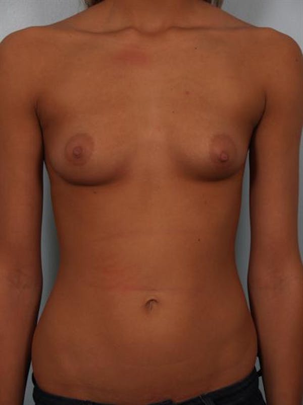 Breast Augmentation Before & After Gallery - Patient 1310267 - Image 1