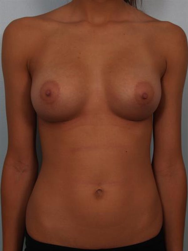 Breast Augmentation Before & After Gallery - Patient 1310267 - Image 2
