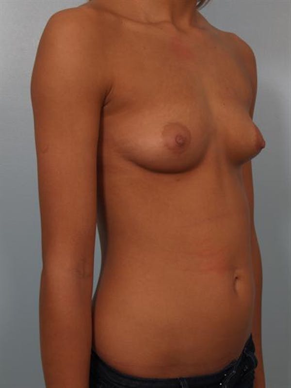 Breast Augmentation Before & After Gallery - Patient 1310267 - Image 5