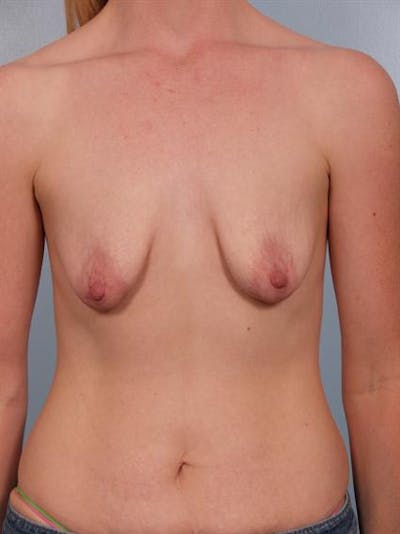 Breast Augmentation Before & After Gallery - Patient 1310268 - Image 1
