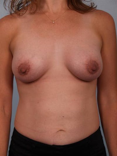 Breast Augmentation Before & After Gallery - Patient 1310270 - Image 4
