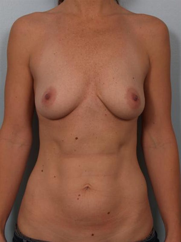 Breast Augmentation Before & After Gallery - Patient 1310273 - Image 3