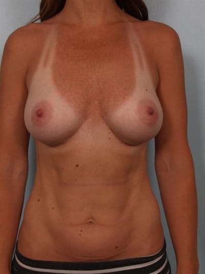 Breast Augmentation Before & After Gallery - Patient 1310273 - Image 4
