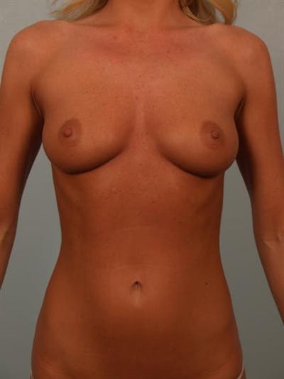 Breast Augmentation Before & After Gallery - Patient 1310275 - Image 1