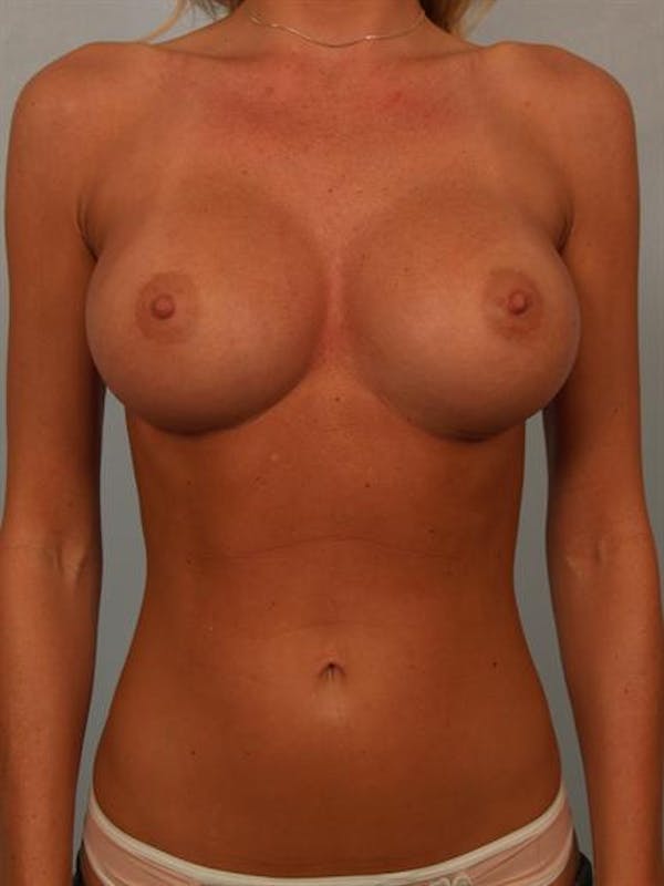 Breast Augmentation Before & After Gallery - Patient 1310275 - Image 2