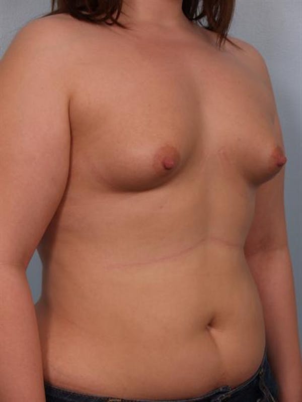 Breast Augmentation Gallery - Patient 1310276 - Image 5